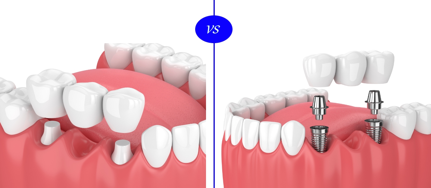 Choosing Between Dental Implants and Bridges A Comprehensive Guide to